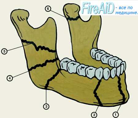 Перелом альвеолярного отростка нижней челюсти. Клиника ( признаки ...