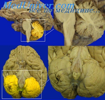 Метаболические расстройства головного мозга. Биохимия патологии головного мозга