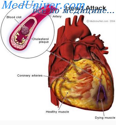 введение инфаркт миокарда