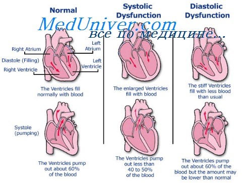 миокардиальная сердечная недостаточность