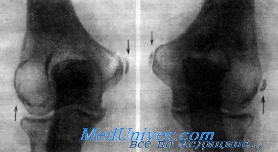 Рентгенологическая диагностика эпикондилита плеча