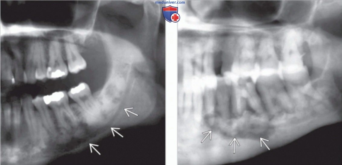 Лучевые признаки генерализованной цементно костной дисплазии зубов