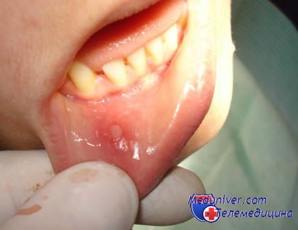 Как лечить язвочки на слизистой оболочке рта у ребенка? Лечение стоматита у детей