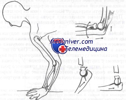 Переломы дистального отдела плечевой кости. Классификация ...