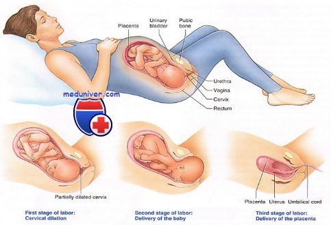 Ведение преждевременных родов при преждевременном разрыве плодных оболочек.