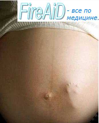 Клиника многоплодной беременности. Диагностика многоплодной беременности.