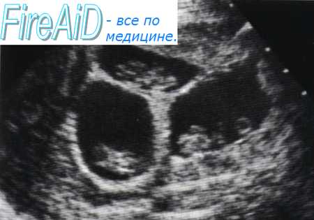 Осложнения беременности в первом ( I ) триместре при многоплодии.
