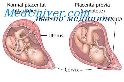 Гиперплазия плаценты