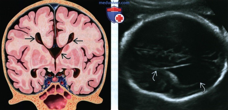 Лучевые признаки агенезии, дисгенезии мозолистого тела у плода