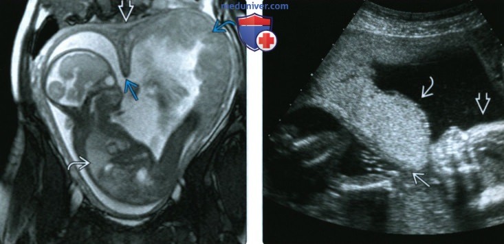 УЗИ, МРТ при аномалии матки у беременной (аномалии мюллерова протока, АМП)