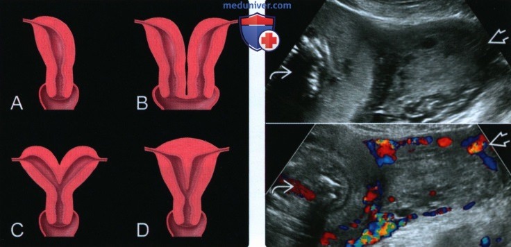 Лучевые признаки аномалии мюллерова протока (АМП) у беременной