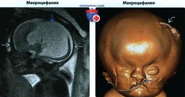 УЗИ, МРТ при аномалиях развития костей свода черепа плода