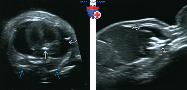Лучевые признаки идиопатической артериальной кальцификации у младенцев (ИАКМ)