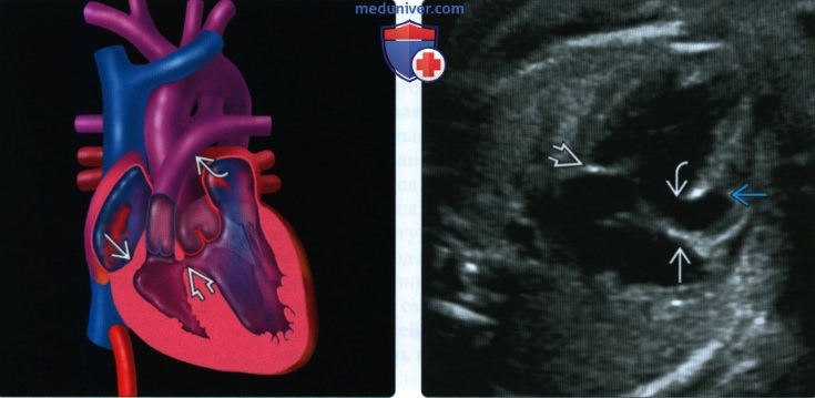 Лучевые признаки атрезии трикуспидального клапана сердца плода