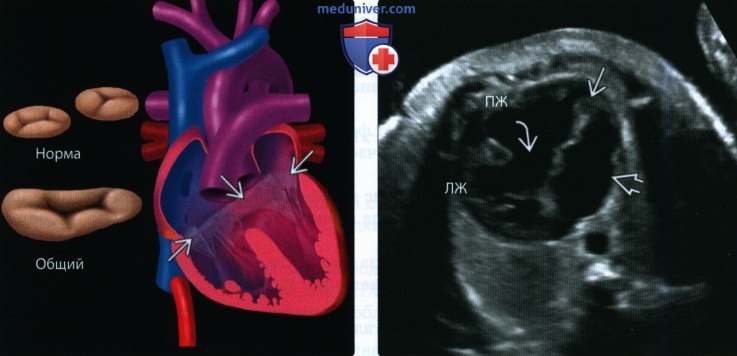 Лучевые признаки атриовентрикулярного септального дефекта сердца плода