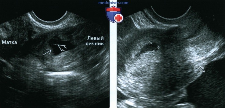 Лучевые признаки беременности в рубце после кесарева сечения