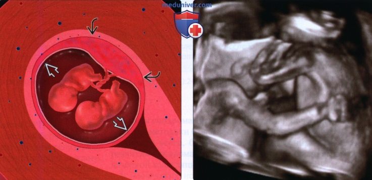 Рекомендации по диагностике многоплодной беременности