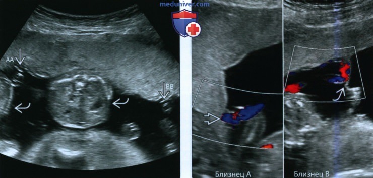 Рекомендации по диагностике многоплодной беременности