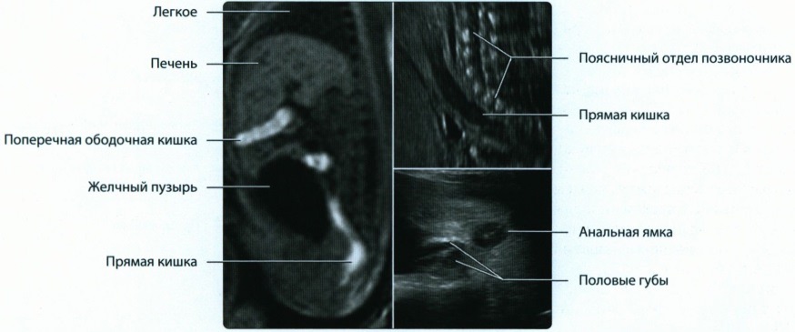 Эмбриогенез, лучевая анатомия передней брюшной стенки и желудочно-кишечного тракта (ЖКТ) у плода