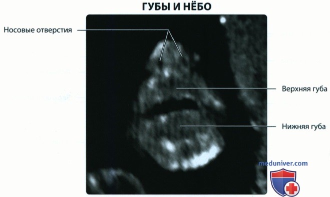 Эмбриогенез, лучевая анатомия лица и шеи плода