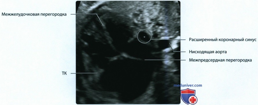 Эмбриогенез и лучевая анатомия сердечно-сосудистой системы у плода