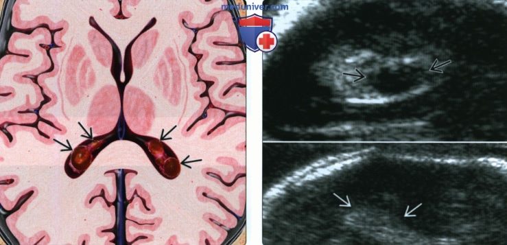 Лучевые признаки кисты сосудистого сплетения (КСС) головного мозга у плода