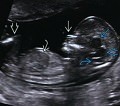 УЗИ в первом триместре беременности