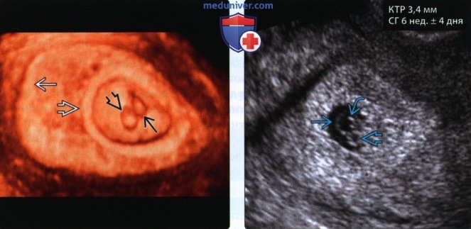 Методы лучевой диагностики и УЗИ анатомия в первом триместре беременности