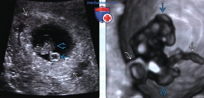 Методы лучевой диагностики и УЗИ анатомия в первом триместре беременности