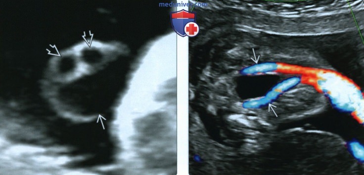 Эмбриогенез, лучевая анатомия плаценты и пуповины