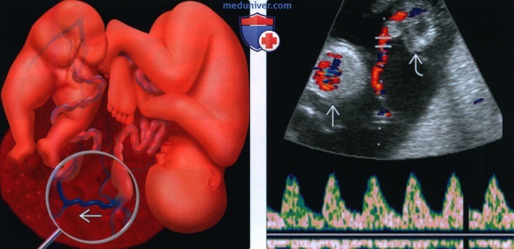Лучевые признаки синдрома обратной артериальной перфузии при многоплодной беременности