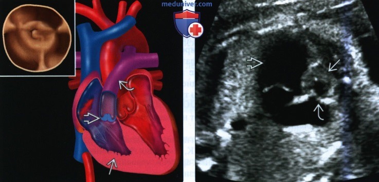 Лучевые признаки стеноза и атрезии легочной артерии сердца плода