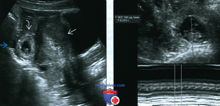 Лучевые признаки внематочной трубной беременности