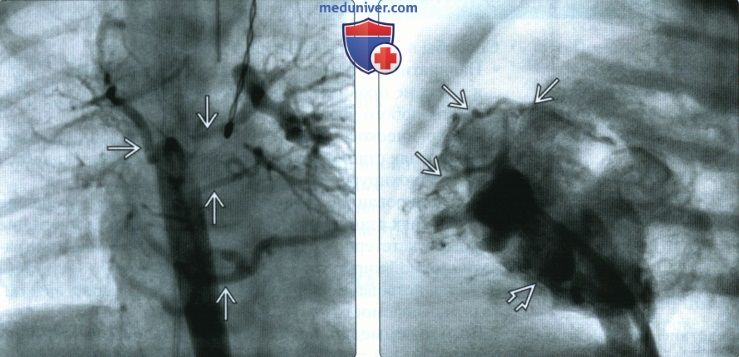 УЗИ, ЭхоКГ при стенозе и атрезии легочной артерии сердца плода