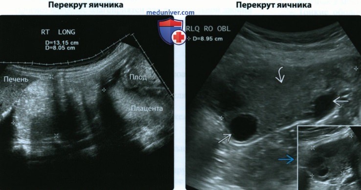 УЗИ, КТ, МРТ острого живота во время беременности