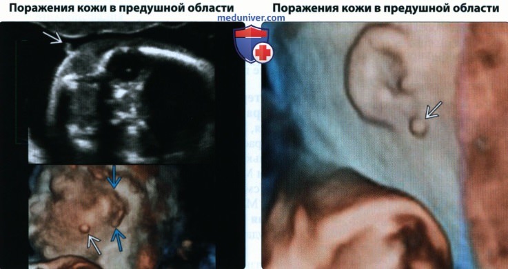 УЗИ, МРТ аномалии развития органа слуха у плода
