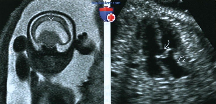 УЗИ, МРТ при диабетической эмбриопатии у плода