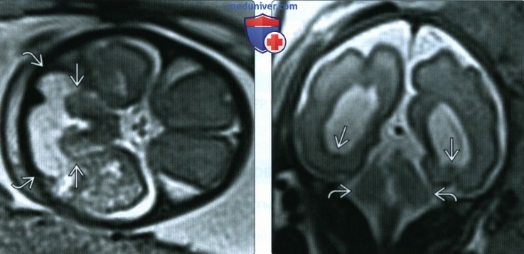 УЗИ, МРТ при гипоплазии мозжечка у плода