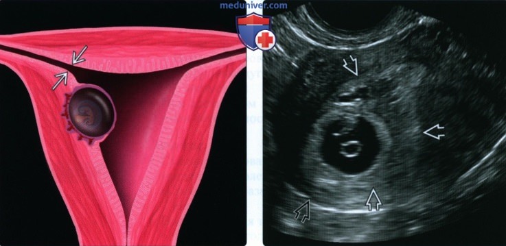 УЗИ, МРТ при интерстициальной трубной беременности