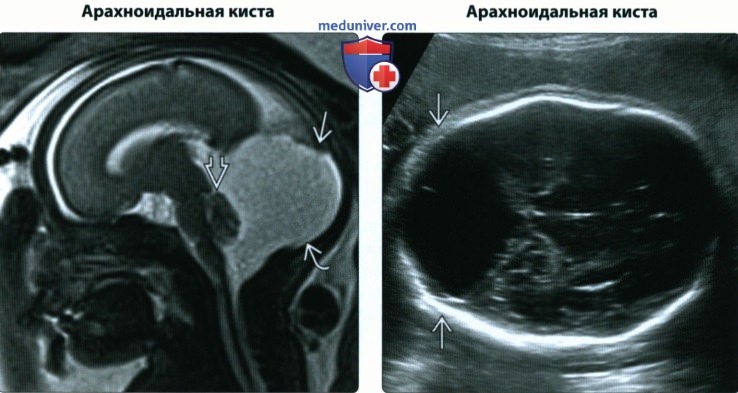 УЗИ, МРТ при кисте задней черепной ямки (скопления жидкости) у плода
