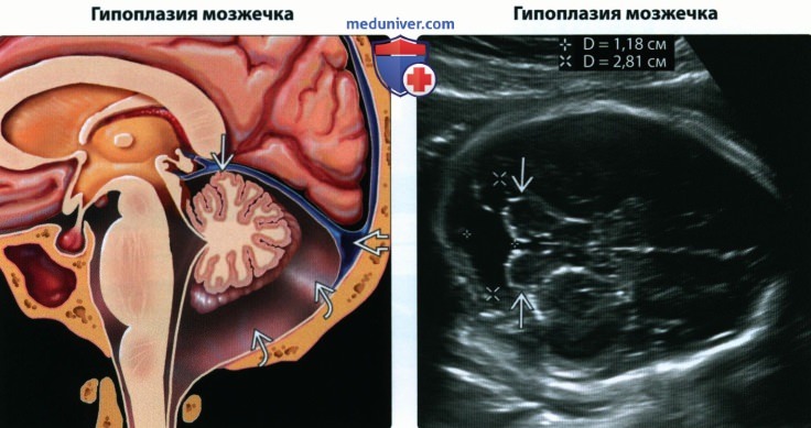 УЗИ, МРТ при кисте задней черепной ямки (скопления жидкости) у плода