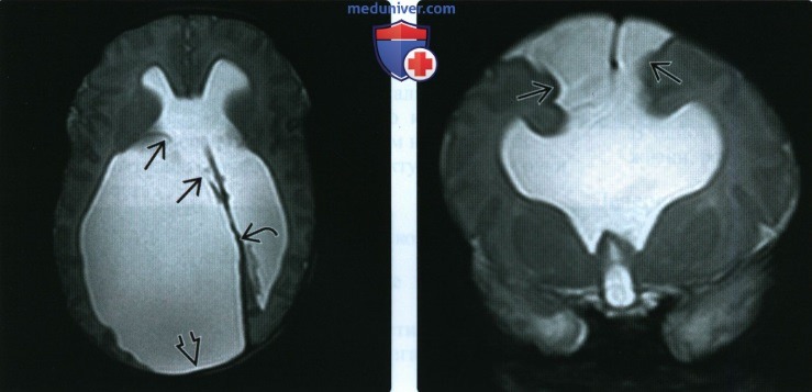 УЗИ, МРТ при межполушарной кисте головного мозга у плода - комплекса AVID