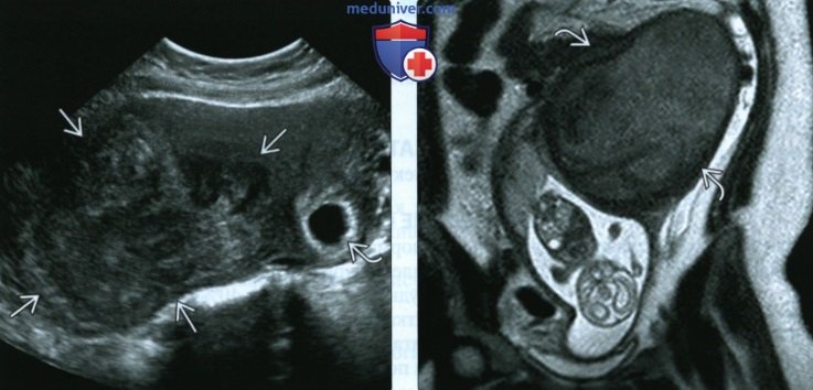 УЗИ, МРТ при миоме матки у беременной