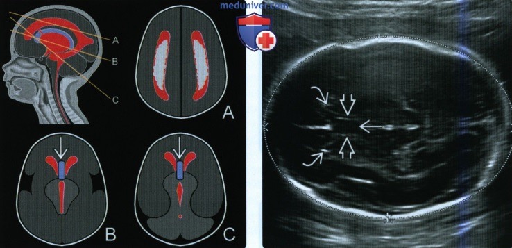 УЗИ, МРТ при отсутствии полости прозрачной перегородки головного мозга плода
