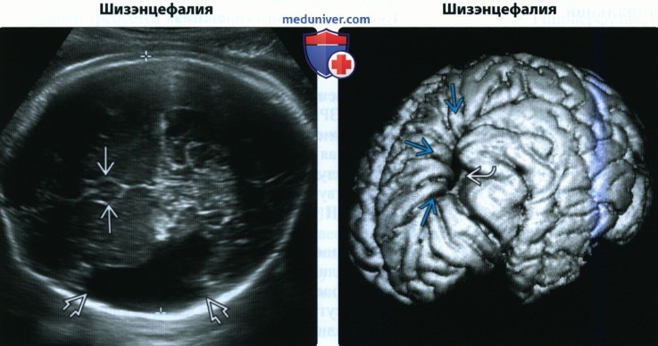 УЗИ, МРТ при отсутствии полости прозрачной перегородки головного мозга плода