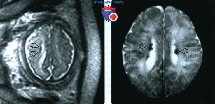 УЗИ, МРТ при туберозном склерозе у плода