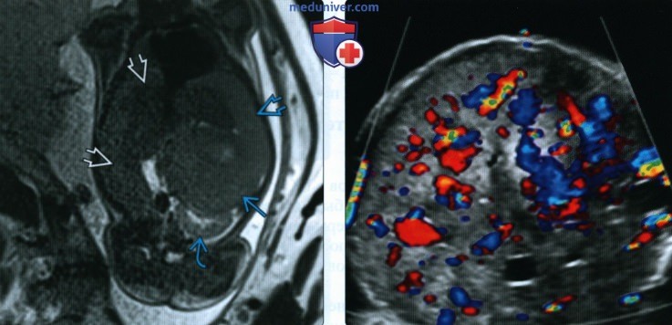 УЗИ, МРТ при злокачественной опухоли печени у плода