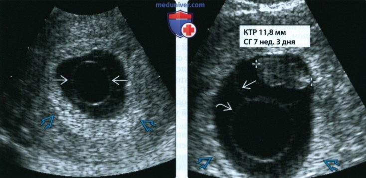 УЗИ при неразвивающейся беременности в первом триместре