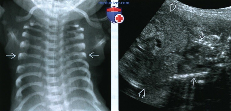 УЗИ, рентгенограмма при синдроме коротких ребер-полидактилии у плода