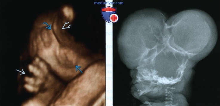 УЗИ, рентгенограмма при танатоформной дисплазии у плода